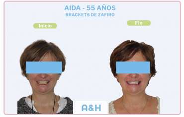 Aida, 55 años – Brackets de Zafiro