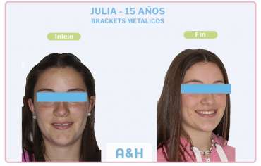 JULIA 15 años – BRACKETS METÁLICOS