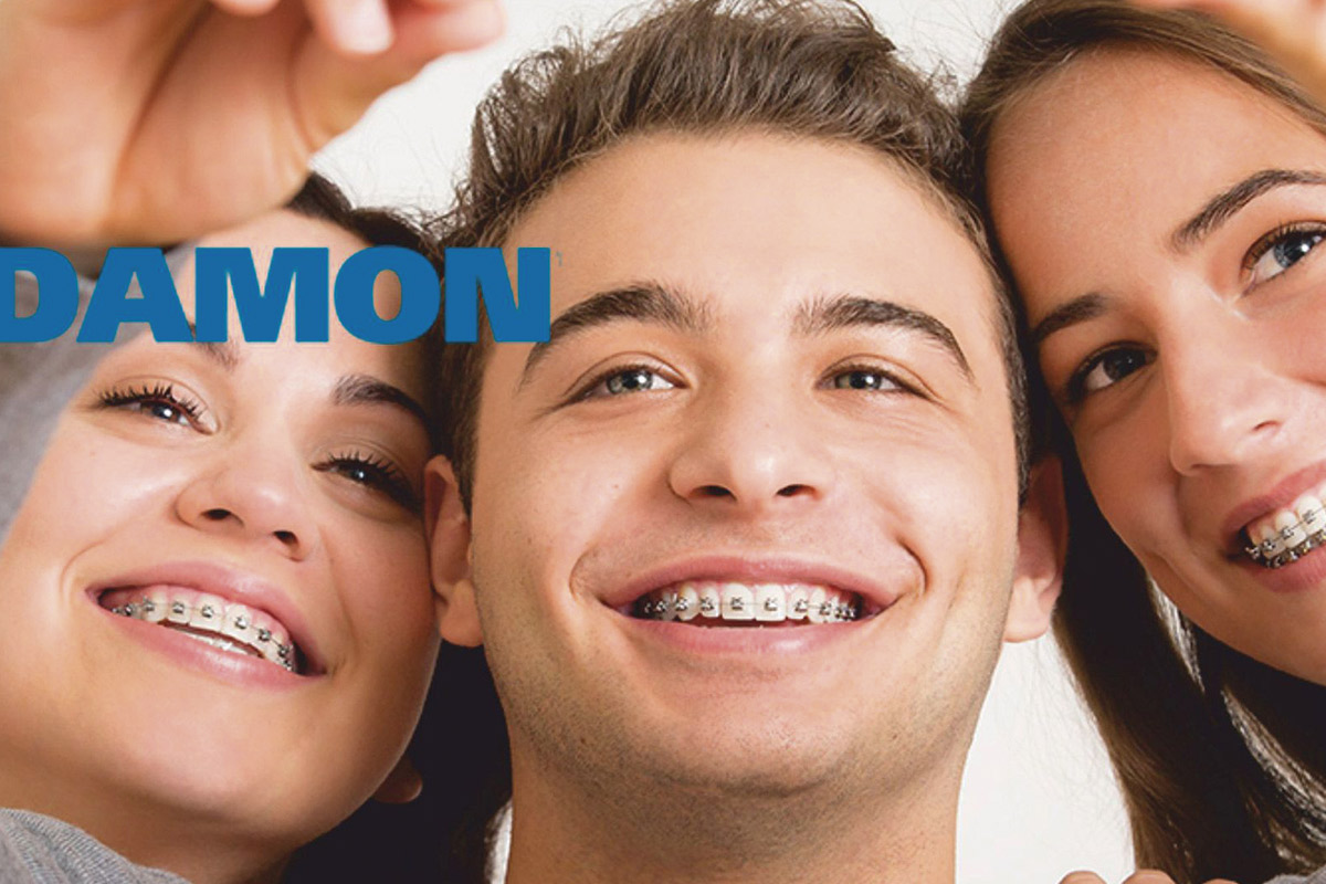 Brackets de Autoligado DAMON » Ortodoncia en Granada