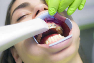 ¿Qué beneficios tiene la Ortodoncia en dientes apiñados?