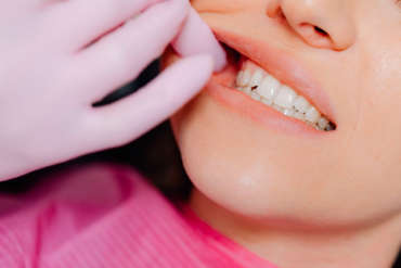 Mitos y realidades sobre el blanqueamiento dental