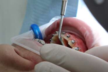 brackets en adolescente