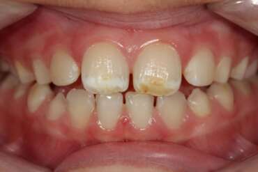 ¿Manchas blancas o amarillas en los dientes de tu hijo? Puede ser hipomineralización