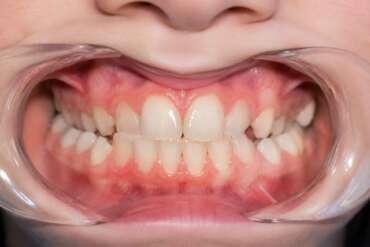 Tipos de mordida: cómo afectan a tu sonrisa y a la salud de tu boca